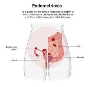 Endometriosis reproductive system medical illustration