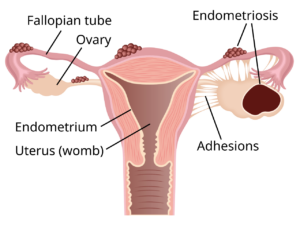 Ovarian endometrioma cyst ultrasound illustration